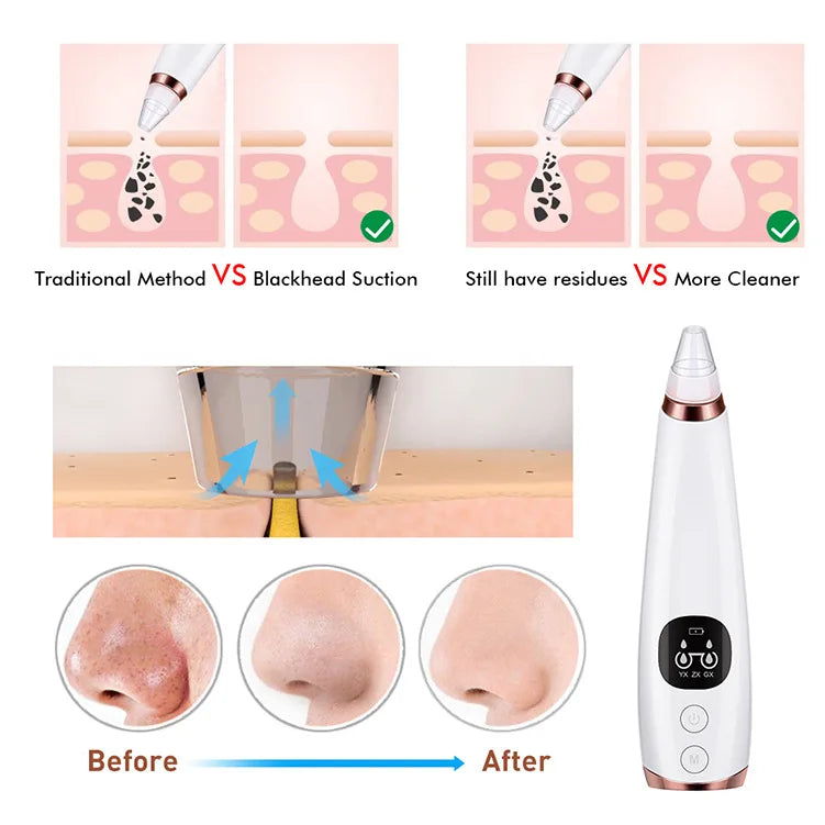 ACNE & BLACKHEAD VACUUM CLEANER